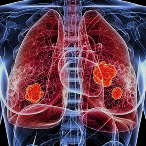 Care for Lung Infections, TB & Interstitial Lung Disease