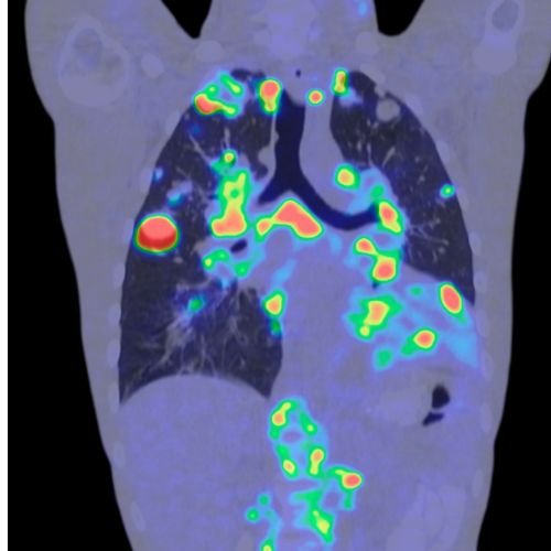 lung cancer screening